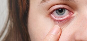 Medicine, health care and eyesight concept. Unrecognizable female shows her inflated red eye with blood capillary, has conjuctivitis. Woman with injured eye